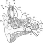 Feature Extraction in Hearing Prostheses