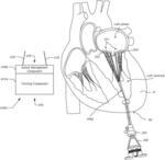 Method and apparatus for cardiac procedures