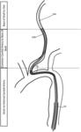 CATHETER SYSTEMS FOR ACCESSING THE BRAIN FOR TREATMENT OF ISCHEMIC STROKE