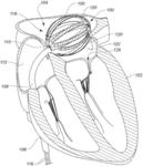 ENHANCED MEDICAL DEVICE FOR USE IN BODILY CAVITIES, FOR EXAMPLE AN ATRIUM