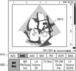 Ultrasound apparatus and ultrasound medical imaging method for identifying view plane of ultrasound image based on classifiers