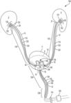 Ureteral and bladder catheters and methods of inducing negative pressure to increase renal perfusion