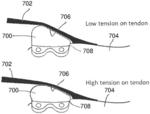 PATELLA TENDON REALIGNMENT IMPLANT WITH CHANGEABLE SHAPE