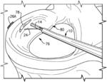 METHOD OF USING SURGICAL DEVICE TO DEPLOY IMPLANTS