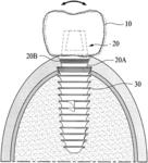 Dental implant unit and method of manufacturing the same