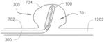 EXPANDABLE BODY DEVICE AND METHOD OF USE