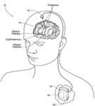 NON-REGULAR ELECTRICAL STIMULATION PATTERNS FOR TREATING NEUROLOGICAL DISORDERS