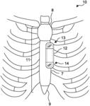 Subcutaneous P-wave centric insertable cardiac monitor with energy harvesting capabilities