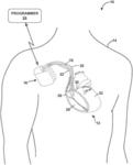 MODULATE PACING RATE TO INCREASE THE PERCENTAGE OF EFFECTIVE VENTRICULAR CAPTURE DURING ATRIAL FIBRILLATION