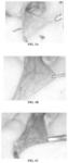 Methods and compositions for treating oral mucositis
