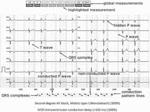 Automatic method to delineate or categorize an electrocardiogram