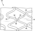 Welded stent with radiopaque material localized at the welds and methods