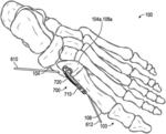 BONE REPOSITIONING GUIDE SYSTEM AND PROCEDURE