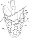 Volume adjustable transtibial socket