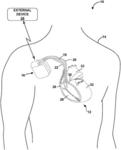 HEART RATE BASED CONTROL OF CARDIAC RESYNCHRONIZATION THERAPY