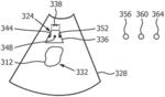 Ultrasound shear wave elastography featuring therapy monitoring