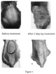 Application of PCSK9 inhibitors in the preparation of drugs for the treatment of inflammatory immune diseases