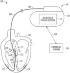 His-bundle pacing capture verification