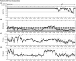 Evaluation of respiratory volume monitoring (RVM) to detect respiratory compromise in advance of pulse oximetry and eliminate false desaturation alarms