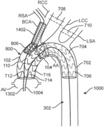 Modular stent device for multiple vessels and method