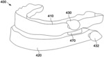 MANDIBULAR ADVANCEMENT APPLIANCE