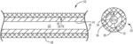 Extra luminal scaffold