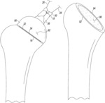 Orthopaedic surgical saw assembly for removing an implanted glenoid component and method of using the same