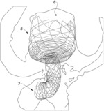 Intra-Aneurysm Device