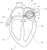 Systems, Devices, Components and Methods for Detecting the Locations of Sources of Cardiac Rhythm Disorders in a Patient's Heart Using Body Surface Electrodes and/or Cardiac Monitoring Patches