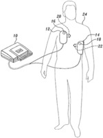 Pulse detection using patient physiological signals