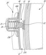 Stand-off device for double-skin combustor liner
