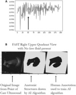 METHOD AND SYSTEMS FOR THE AUTOMATED DETECTION OF FREE FLUID USING ARTIFICIAL INTELLIGENCE FOR THE FOCUSED ASSESSMENT SONOGRAPHY FOR TRAUMA (FAST) EXAMINATION FOR TRAUMA CARE