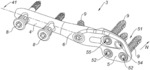 INTRAMEDULLARY IMPLANT FOR TRANSVERSE OSTEOTOMY