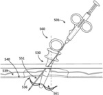 Needle and guide apparatus for passing suture