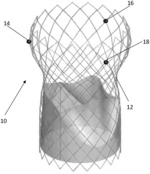 SYSTEM FOR MONITORING OF THE FUNCTIONAL STATUS OF IMPLANTED HEART VALVES