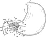 STENT AND ASSOCIATED SYSTEMS AND METHODS