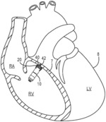 MEDICAL DEVICE AND METHOD FOR CONTROLLING PACING INTERVAL TO PROMOTE MECHANICAL HEART CHAMBER SYNCHRONY