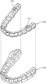 OCCLUSAL BLOCK DESIGN FOR LATERAL LOCKING