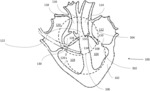 CARDIAC CONTRACTILITY MODULATION FOR ATRIAL ARRHYTHMIA PATIENTS