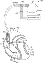 METHOD AND SYSTEM FOR IMPLANTING A SEPTAL WALL ELECTRODE