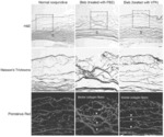 USE OF VALPROIC ACID FOR REDUCING POST-OPERATIVE SCARRING FOLLOWING A GLAUCOMA SURGERY