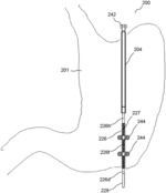 GASTRIC RESTRICTIVE DEVICE