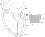 Apparatus and methods for delivery of a prosthetic valve within an existing implanted prosthetic valve