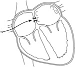 IMPLANTABLE SHUNT SYSTEMS AND METHODS