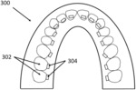 Indirect orthodontic bonding systems and methods for bracket placement