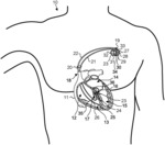SYSTEM FOR BRUGADA SYNDROME PRESENCE-BASED ELECTRICAL THERAPEUTIC STIMULATION DELIVERY