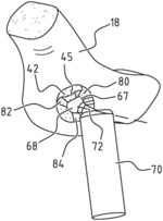 Implant, fitting plate and method of manufacturing an implant and fitting plate