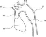 Graft for treating the distal aortic arch and descending aorta in type a patients
