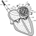 Medical device for use in bodily lumens, for example an atrium