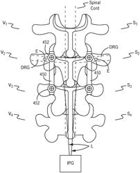 Methods and systems for implanting a neuromodulation system and a spinal fixation system at a surgically open spinal treatment site with direct visual and/or physical access to targeted dorsal root ganglion